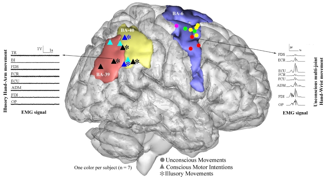 Direct cortical stimulation map