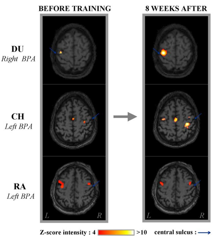 Motor plasticity after amputation