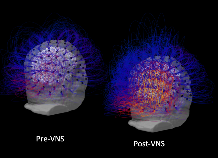 EEG connectivity before and after vagus nerve stimulation